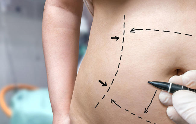 Tummy Tuck: 4 Questions to Know If It’s the Right Procedure for You