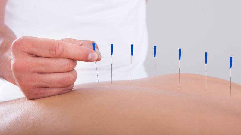 The Benefits of Dry Needling in Lafayette