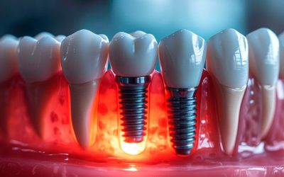 Benefits of Choosing Dental Implants In Little Rock AR For Missing Teeth Solutions